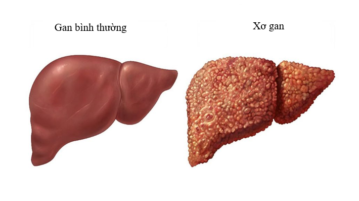 30% trường hợp gan nhiễm mỡ tiến triển thành xơ gan