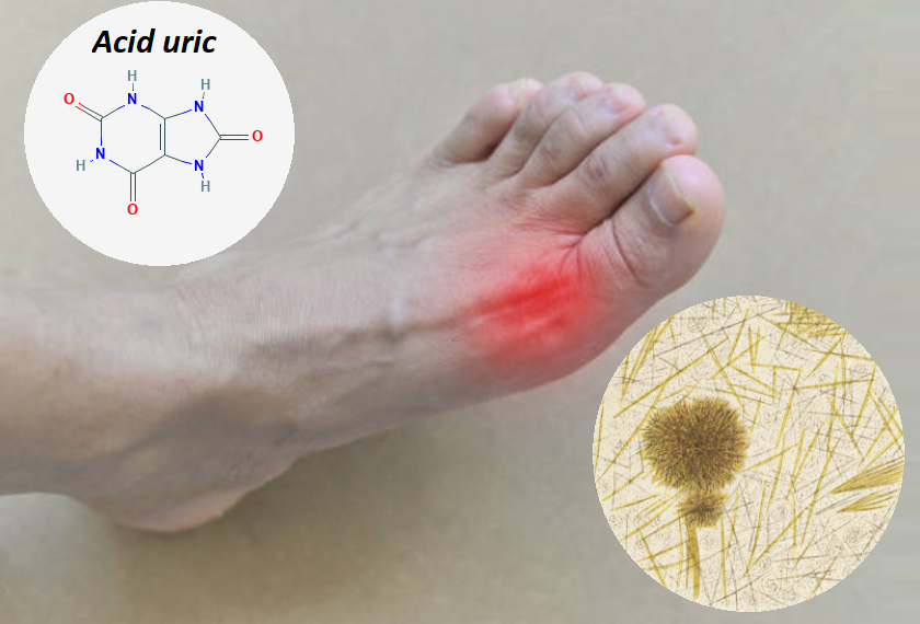 Acid uric là gì?