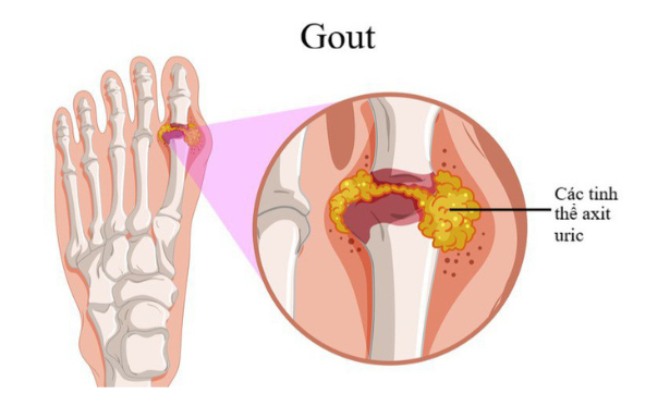 Bệnh gút khiến bệnh nhân vô cùng đau đớn