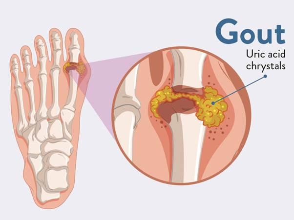 Bệnh gút là gì?