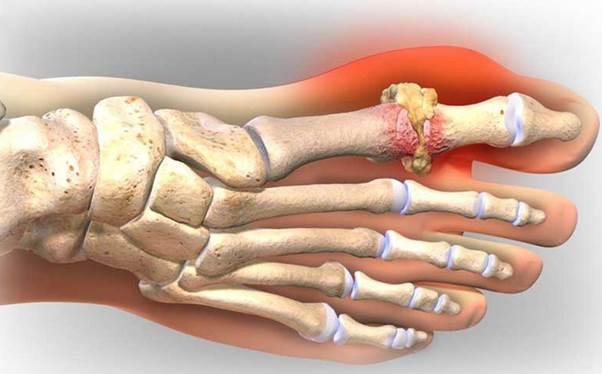 Bệnh gút nguy hiểm như thế nào?