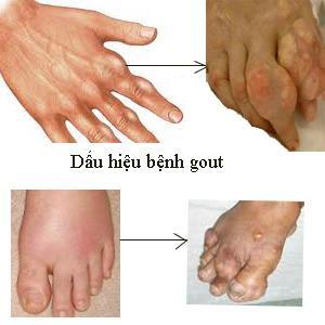 Biểu hiện của bệnh gút