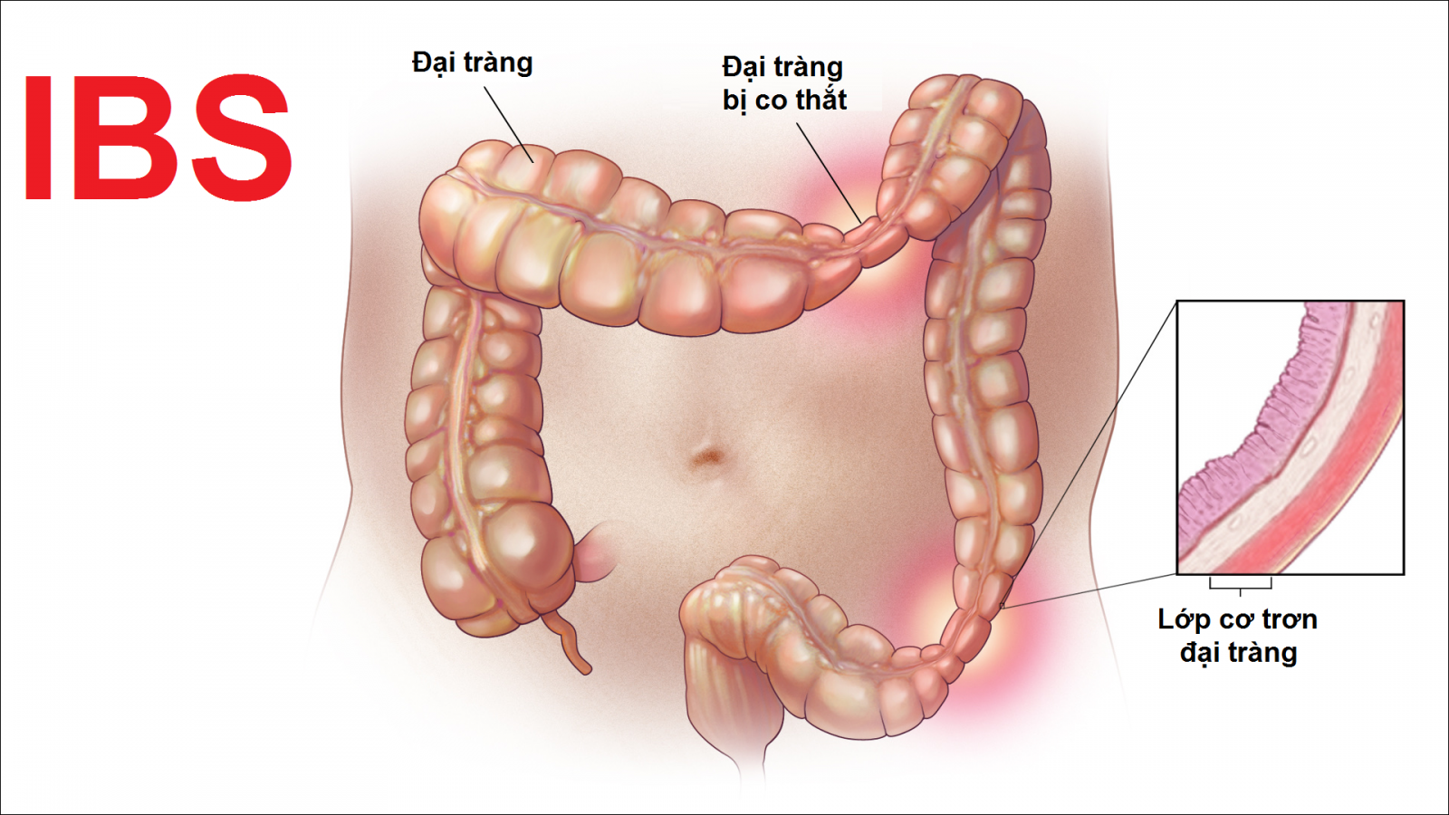 Đại tràng bị co thắt quá mức ở người bị hội chứng ruột kích thích