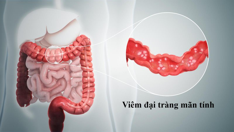 Đi ngoài nhiều lần trong ngày có thể do viêm đại tràng mãn tính