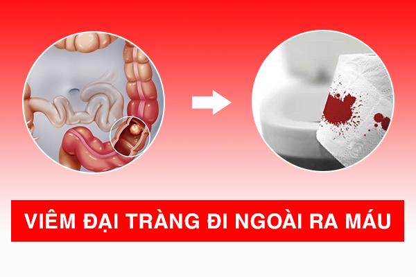 Viêm đại tràng đi ngoài ra máu có nguy hiểm không?