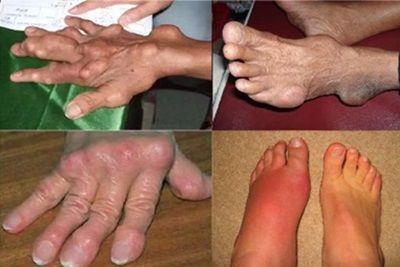 Hình ảnh bệnh gout