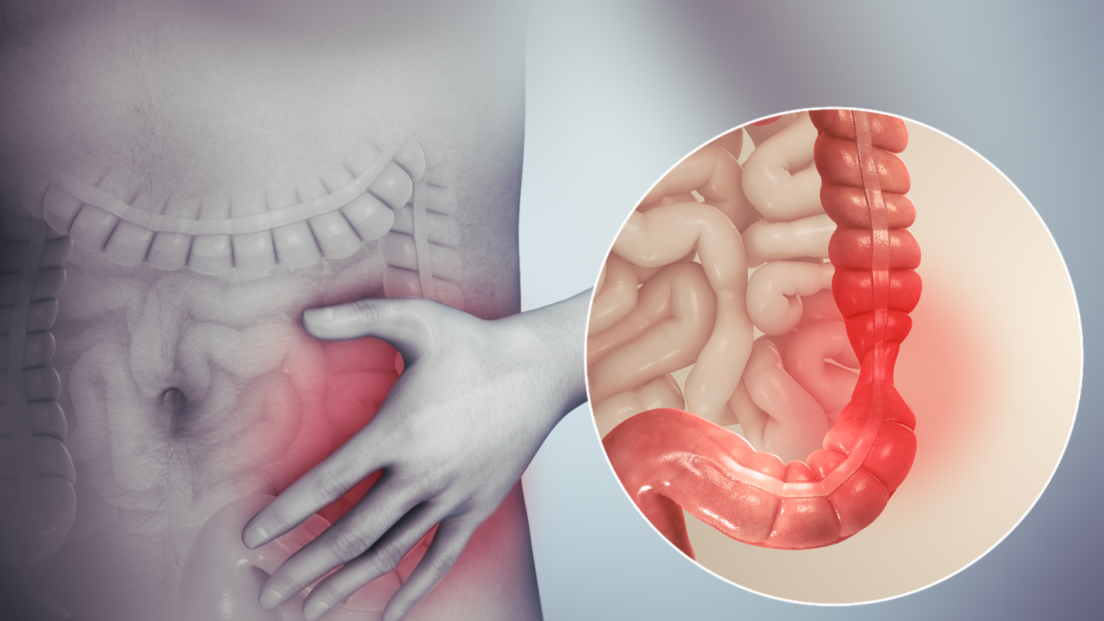 Hội chứng ruột kích thích là gì?