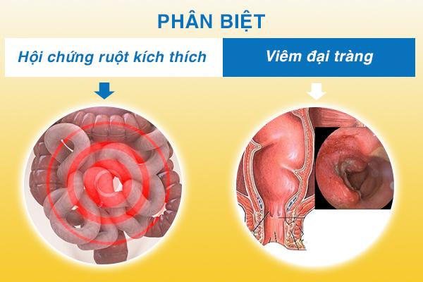 Hội chứng ruột kích thích và viêm đại tràng là 2 bệnh dễ nhầm với nhau