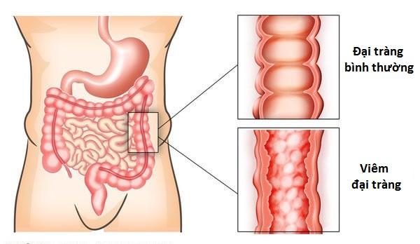 Nguyên nhân và triệu chứng bệnh viêm đại tràng là gì