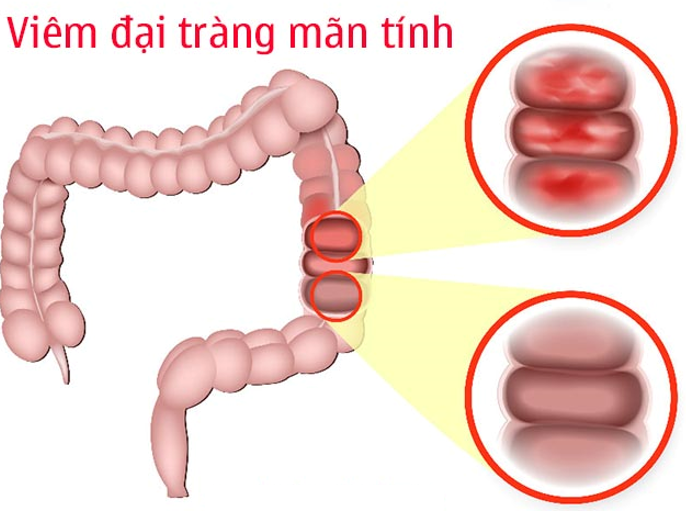 Những sai lầm mà người bệnh viêm đại tràng mãn tính thường gặp