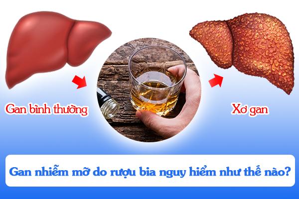 Gan nhiễm mỡ do rượu bia nguy hiểm như thế nào?