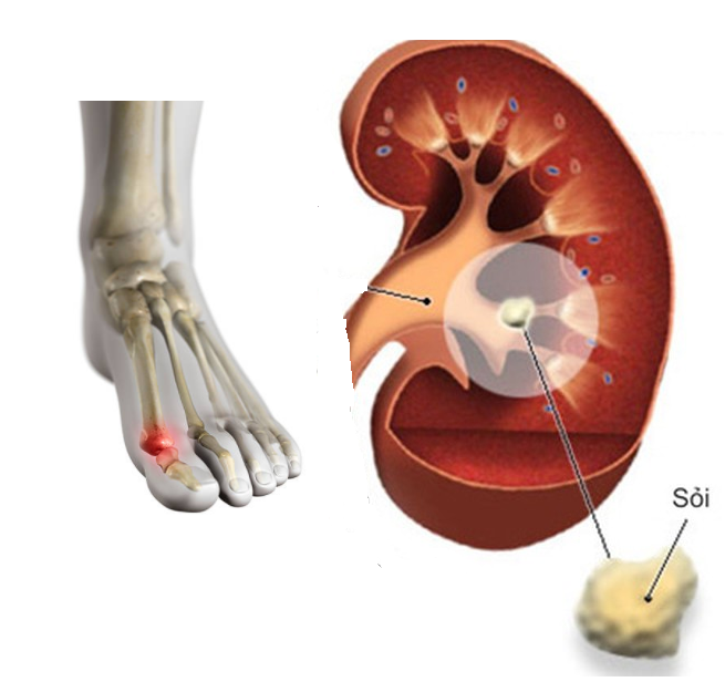 Sỏi thận là một biến chứng của bệnh gút