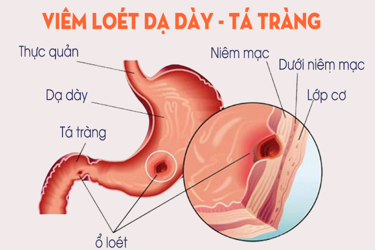 Sử dụng Glucocorticoid gây ra nhiều tác dụng phụ, trong đó có loét dạ dày tá tràng