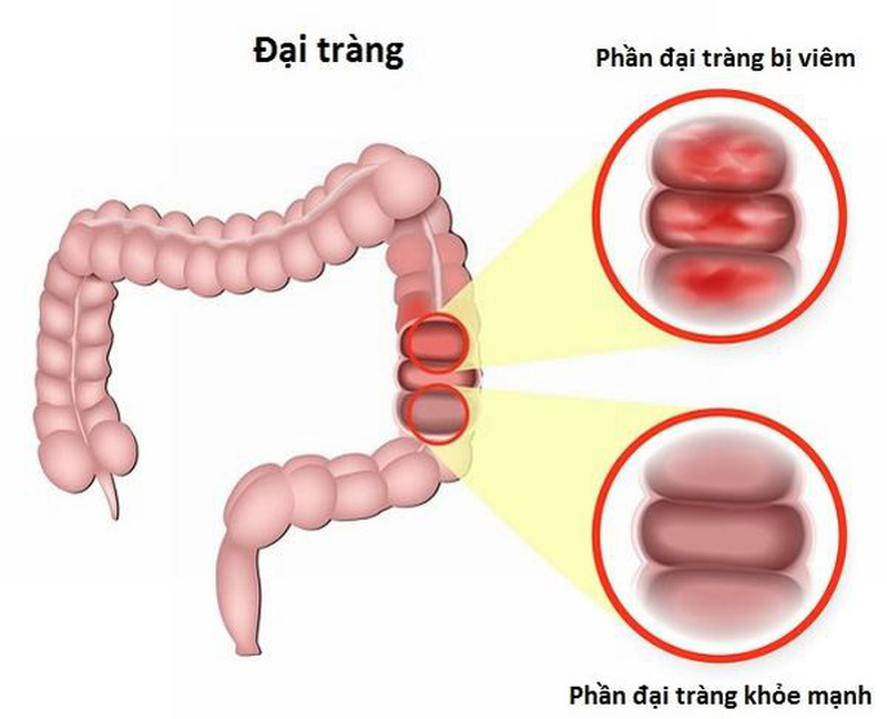 Viêm đại tràng mãn tính gây rối loạn tiêu hóa