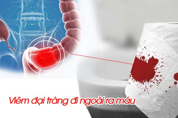 Giải pháp đối phó với viêm đại tràng đi ngoài ra máu là gì?