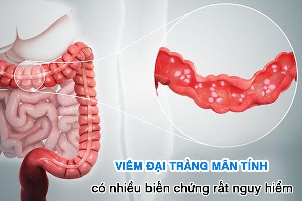 5 Thảo dược tốt cho người bệnh viêm đại tràng mãn tính