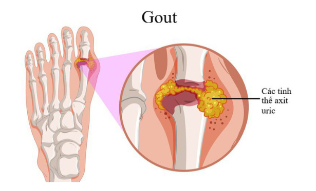 Bị bệnh gút nhưng hiện giờ sức khỏe bình thường, không đau thì có cần dùng BoniGut không?