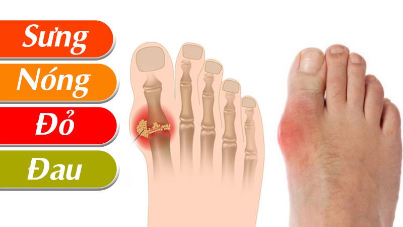 Bệnh Gout thường đau ở đâu? Các dấu hiệu nhận biết bệnh Gout