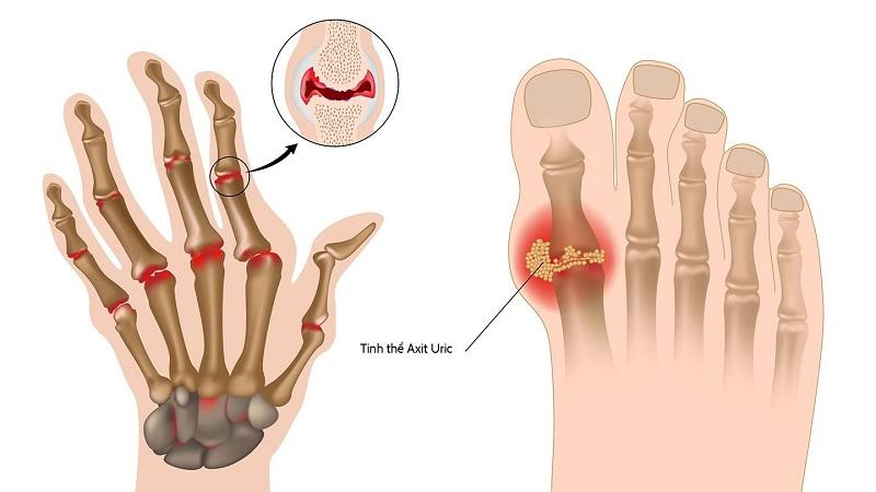 Cảnh báo: Sử dụng thuốc tây gây nhiều tác dụng phụ nghiêm trọng đối với người bệnh gút