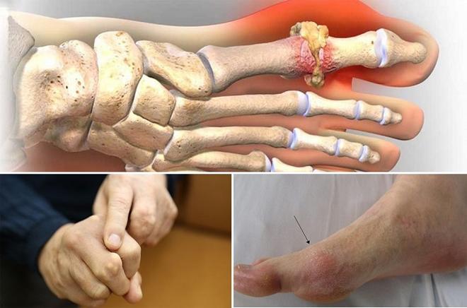 Cách phối hợp thảo dược trong cải thiện bệnh gout theo y học cổ truyền là gì?