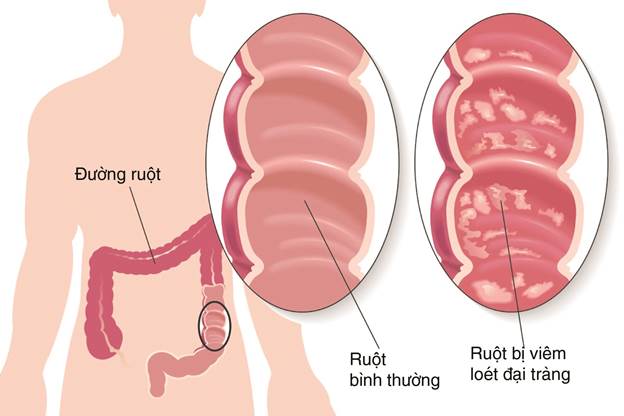 Dùng BoniBaio có cần kèm thêm men tiêu hóa không?