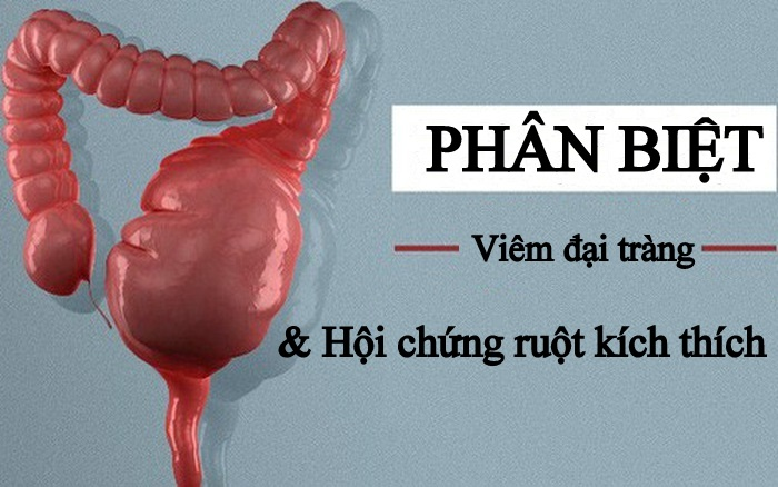 Phân biệt giữa hội chứng ruột kích thích và viêm đại tràng