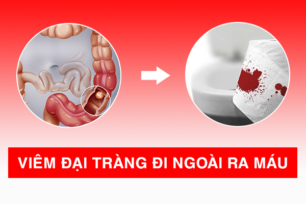 Viêm đại tràng đi ngoài ra máu có nguy hiểm không? Giải pháp khắc phục tối ưu là gì?