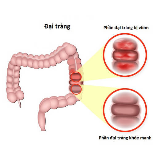 Tôi bị viêm đại tràng mãn tính từ 10 năm nay, đi bệnh viện uống thuốc chỉ đỡ nhưng không hết được. Sao bệnh của tôi lại hay tái phát như vậy?